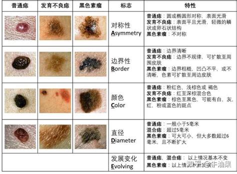 臉上突然長痣怎麼辦|是痣還是瘤？黑色素瘤的類型、症狀與治療